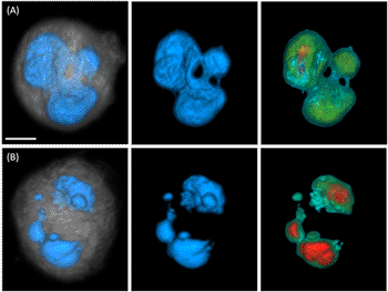 Image: Instances of irregular MDA-MB-231 nuclear morphologies (scale bar = 5 microns). Panel (A) depicts a multilobular nucleus and panel (B) illustrates a cell with micronuclei. Left images show nuclear surface in blue and cytoplasm in gray, middle images show surface-shaded renderings of the nuclear volume and right images depict volume renderings through the nuclear volume. Increasing nuclear density is color coded from green to red (Photo courtesy of the Biodesign Institute / University of Arizona).